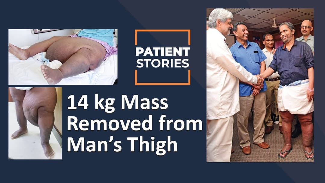 Shreya - Asia's first upper arm double hand transplantation