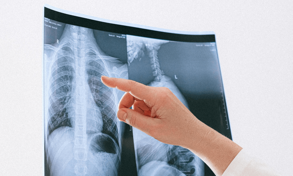 Early Detection of Lung Cancer: Why It Matters ?